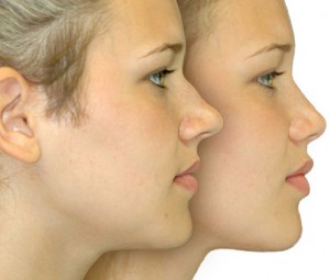 Rhinoplastie
