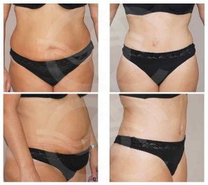 photos-abdominoplastie-tunisie